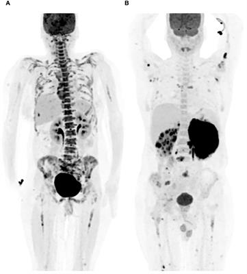 A comprehensive review of the role of bone marrow biopsy and PET-CT in the evaluation of bone marrow involvement in adults newly diagnosed with DLBCL